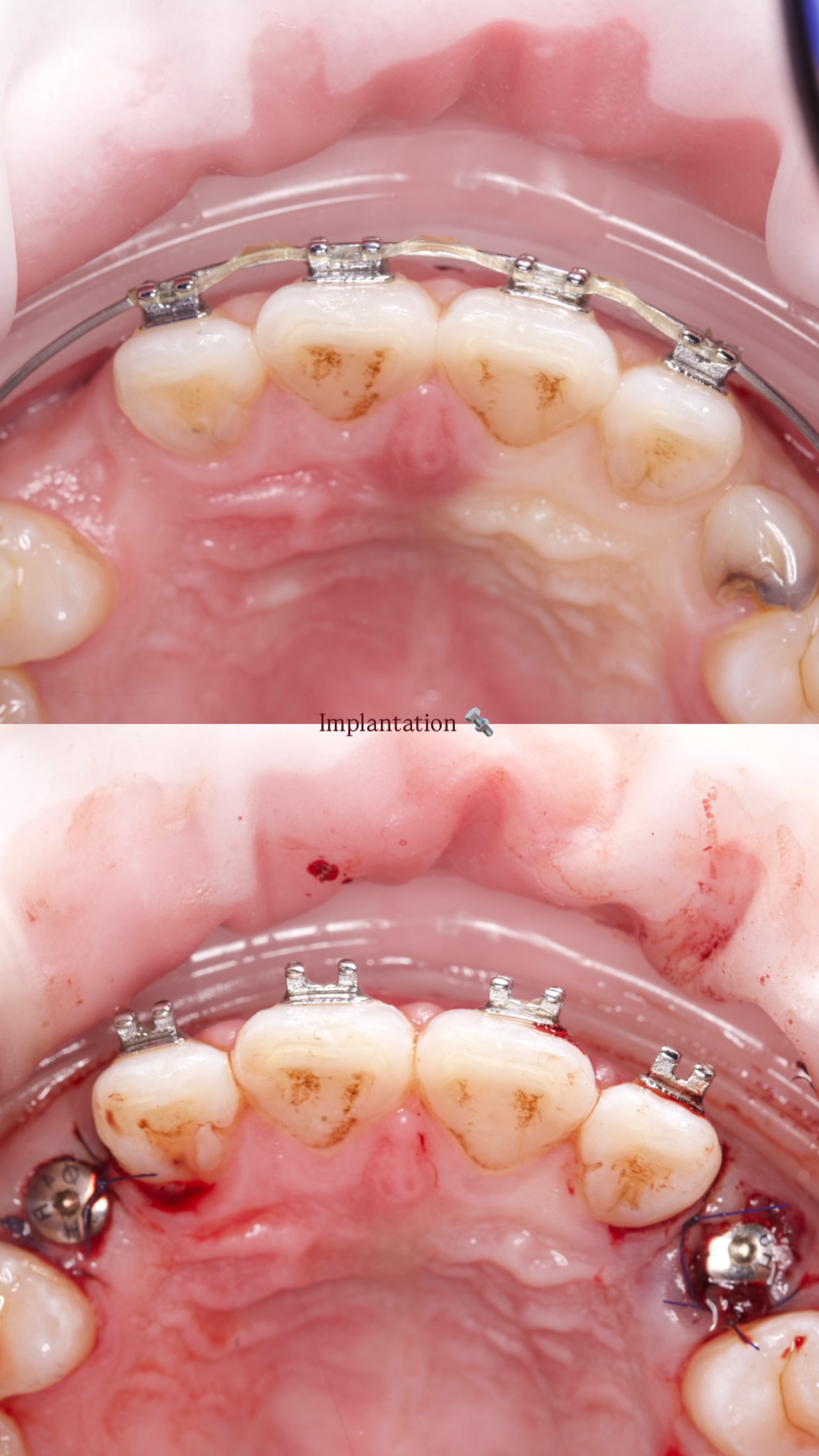 Имплантация